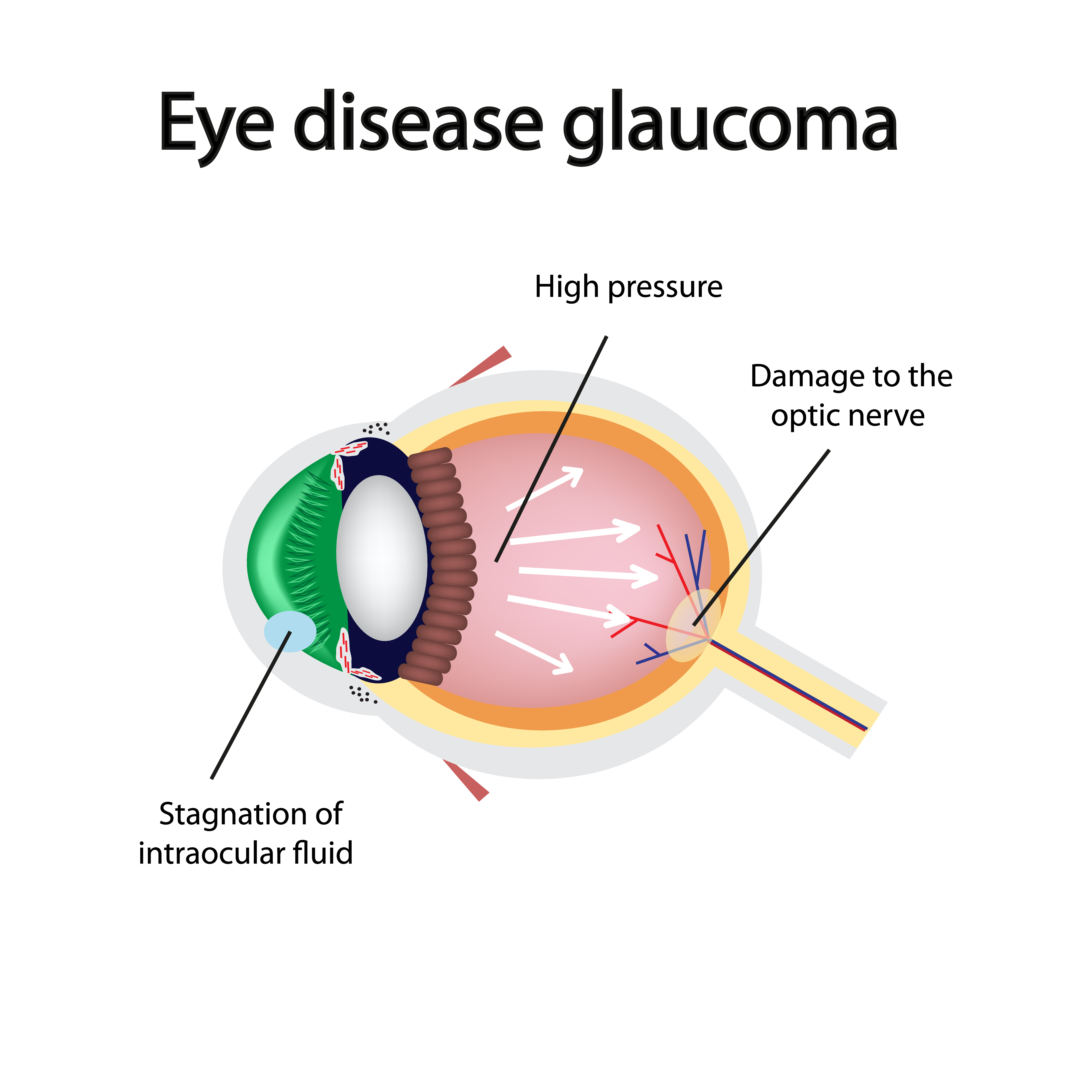 Eye disease glaucoma diagram